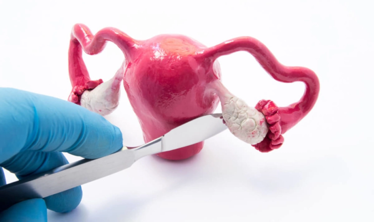 Що таке кіста яєчника: симптоми, причини розвитку захворювання та лікування